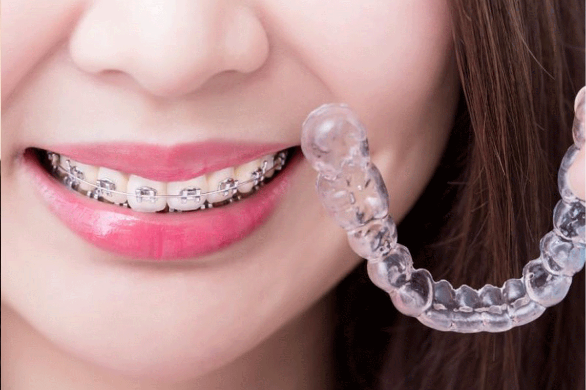 How Much Do Private Braces Cost?