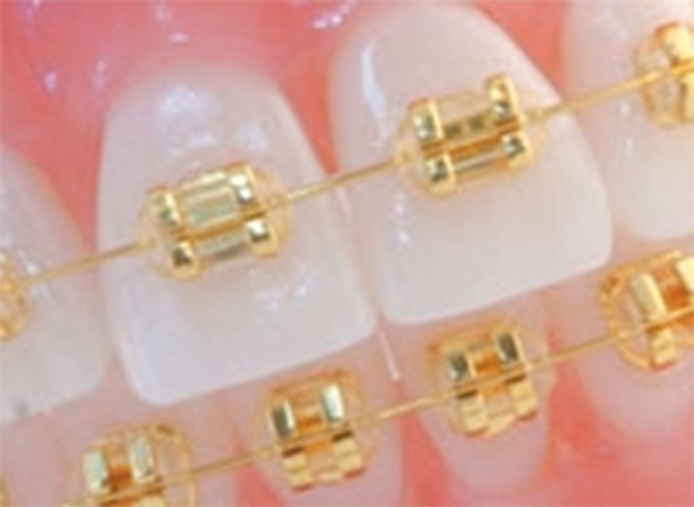 Gold brackets