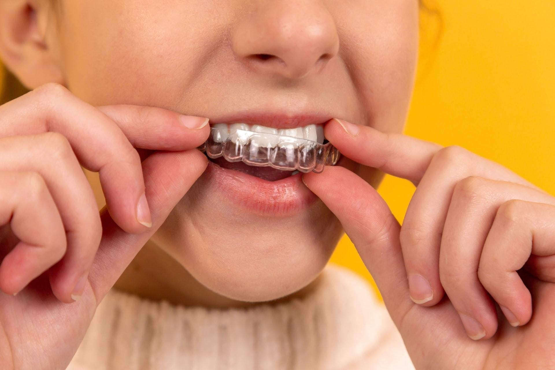 How to Wear Your Orthodontic Dental Retainer