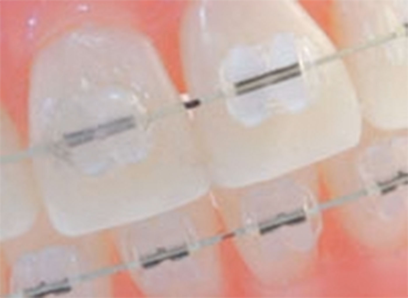 Ceramic brackets